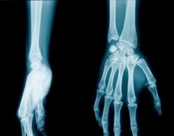 Illustration d'une fracture du scaphoïde - Photo : DR